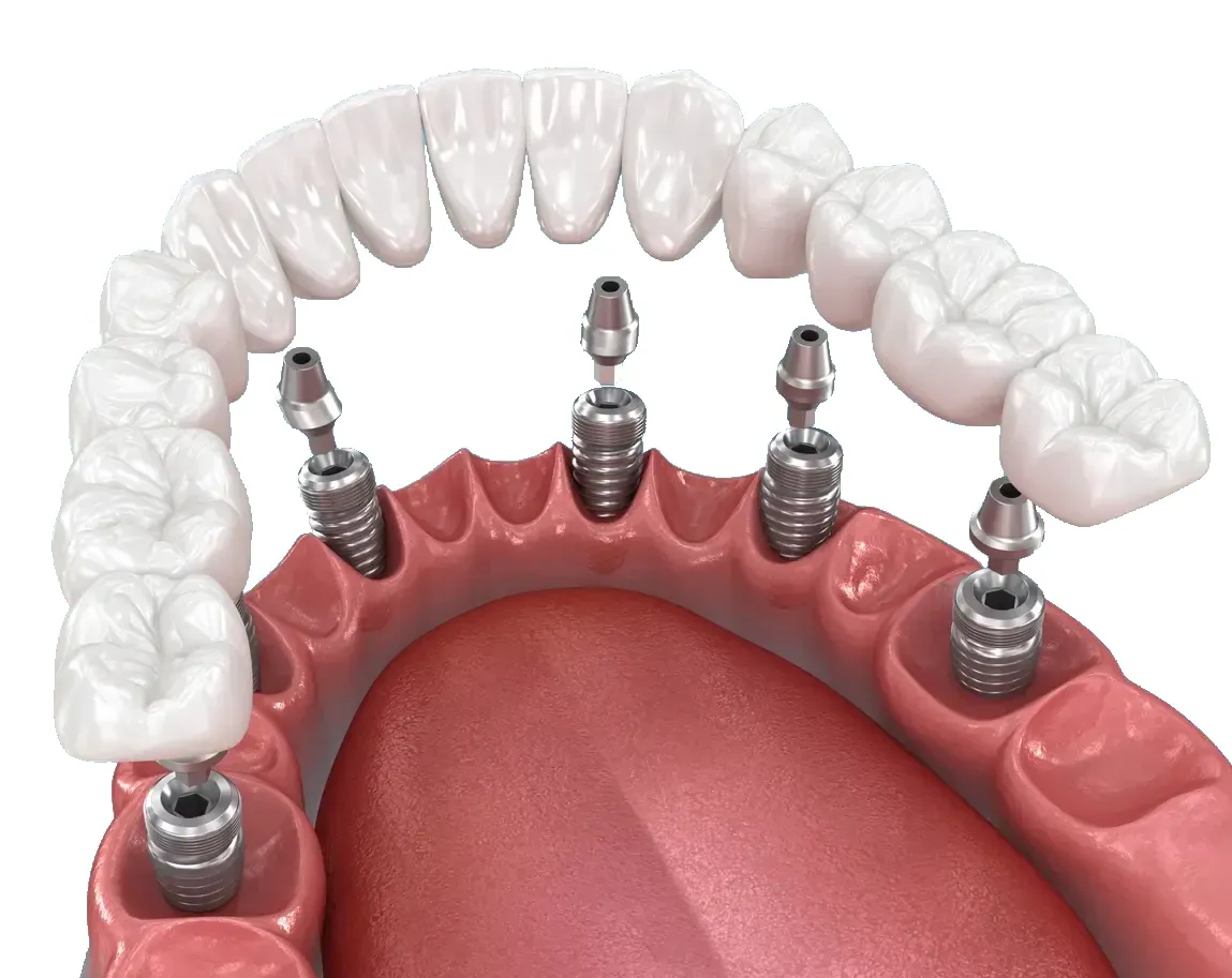 Illustration of a full-arch lower restoration supported by six dental implants